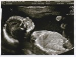 20 Weeks Scan July 2015 1